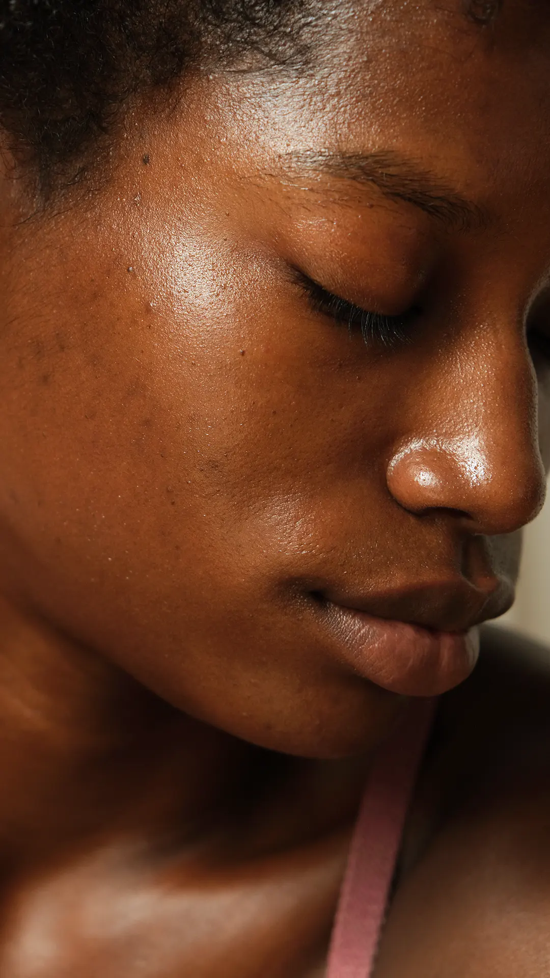 Excès de sébum - B.